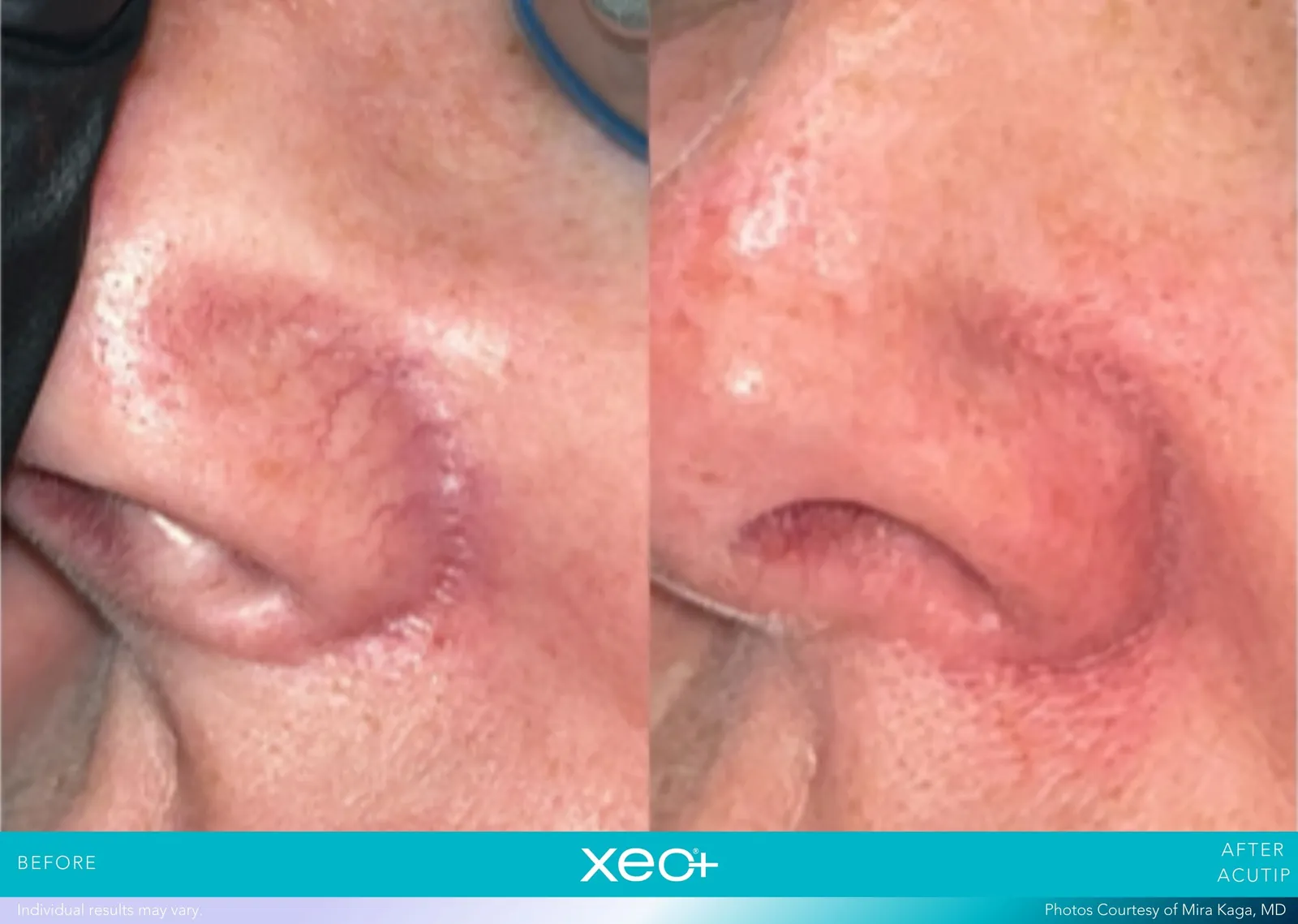 Before and after AcuTip treatment, Cutera xeo+ manufacturer clinical photo