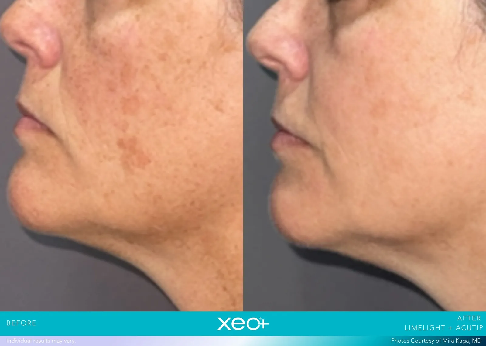Before and after LimeLight + AcuTip treatment, Cutera xeo+ manufacturer clinical photo