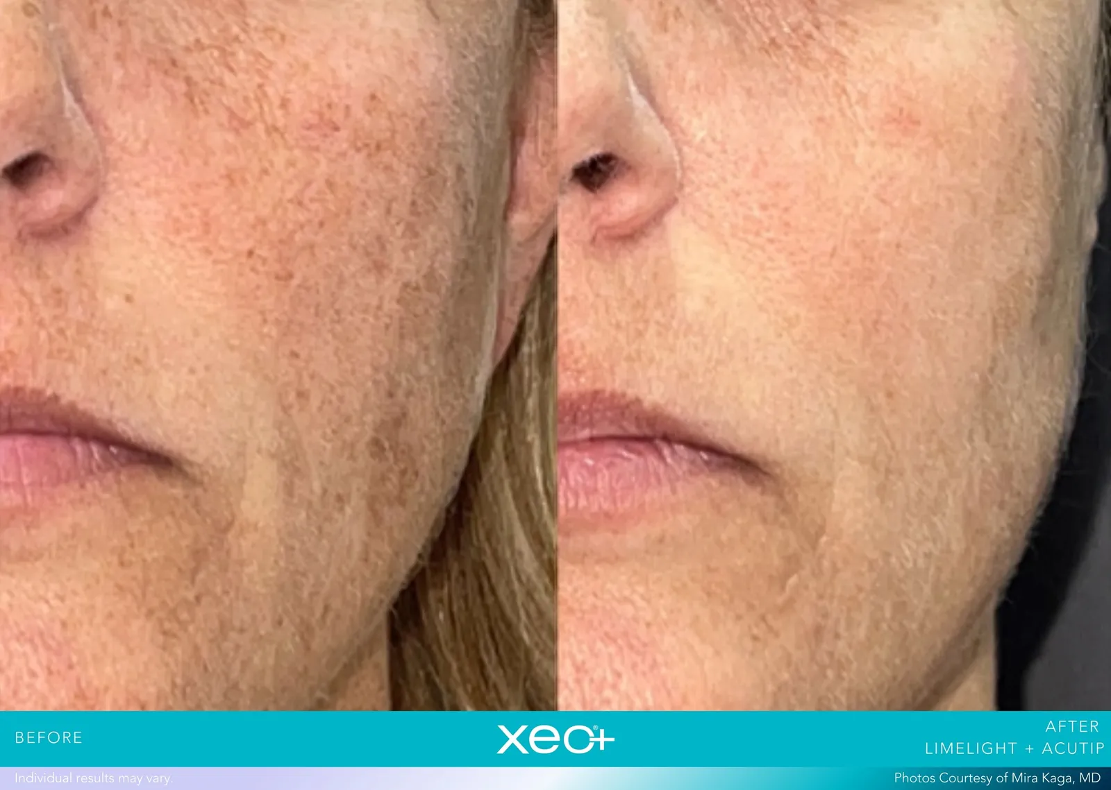 Before and after LimeLight + AcuTip treatment, Cutera xeo+ manufacturer clinical photo
