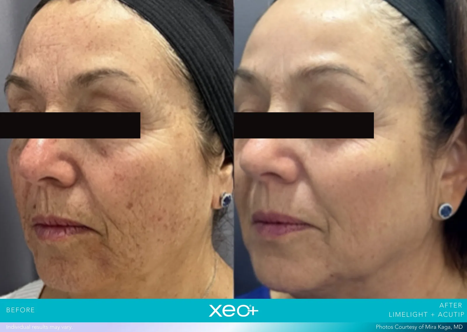 Before and after LimeLight + AcuTip treatment, Cutera xeo+ manufacturer clinical photo