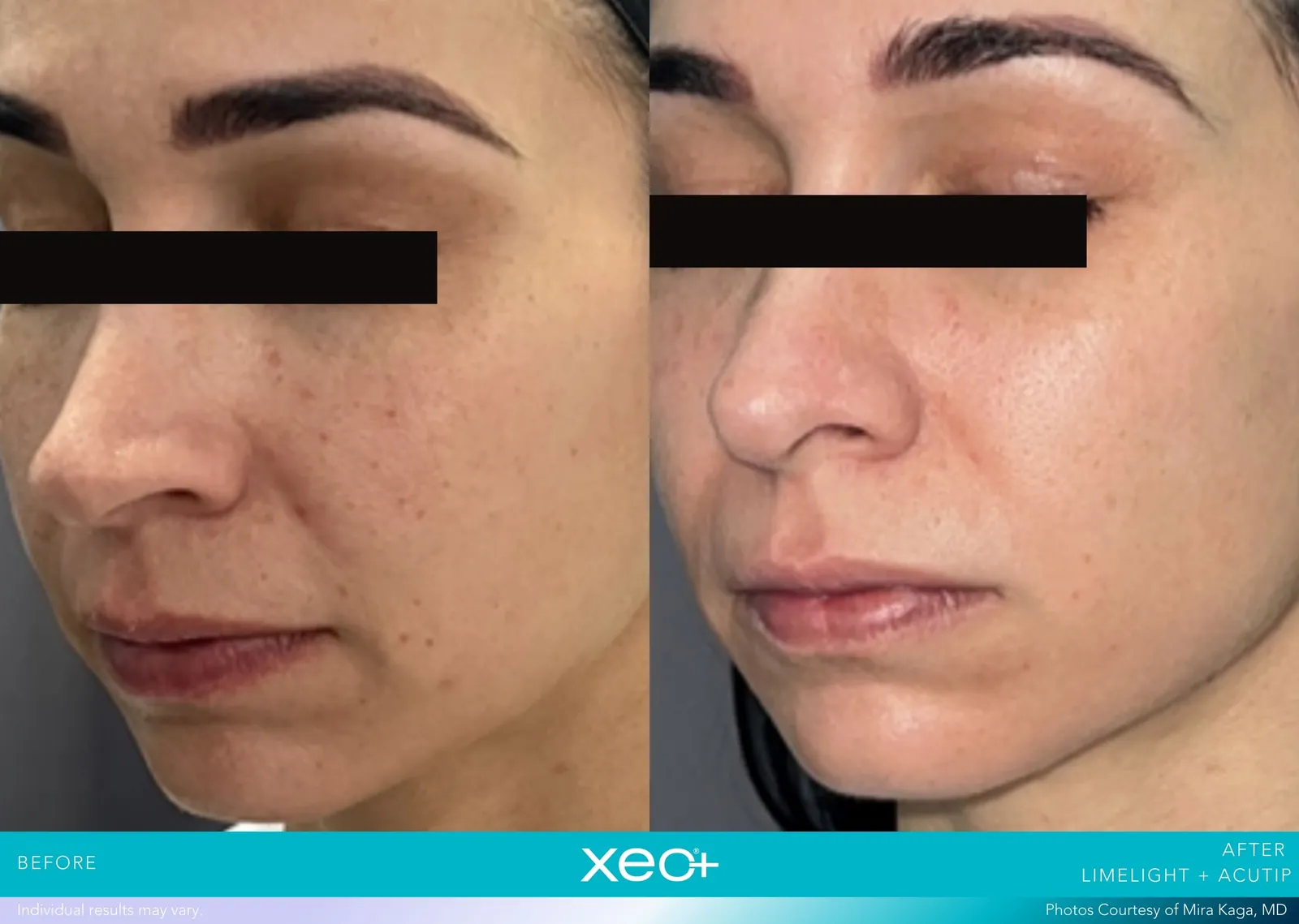 Before and after LimeLight + AcuTip treatment, Cutera xeo+ manufacturer clinical photo