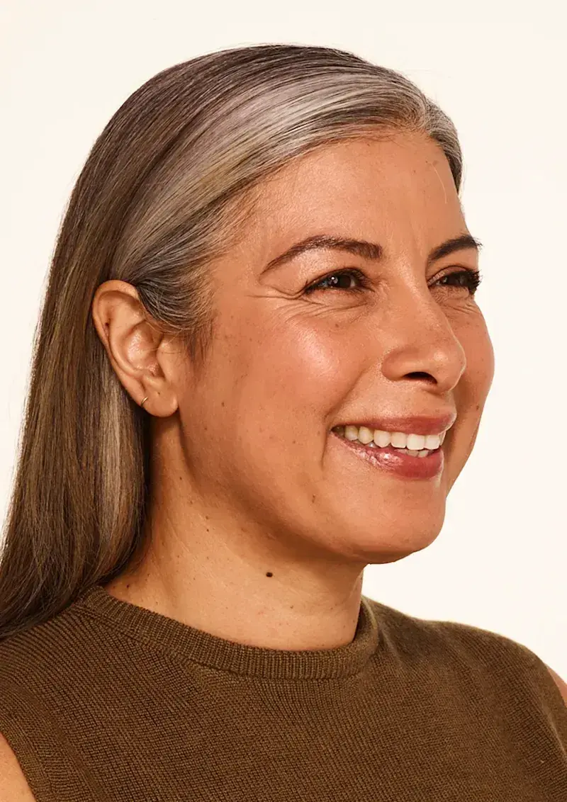 Before BOTOX Cosmetic treatment, Allergan Aesthetics manufacturer clinical photo