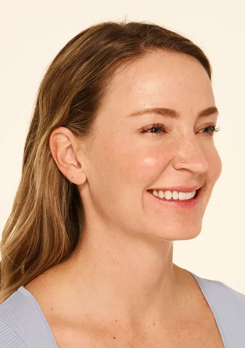 30 days after BOTOX Cosmetic treatment, Allergan Aesthetics manufacturer clinical photo