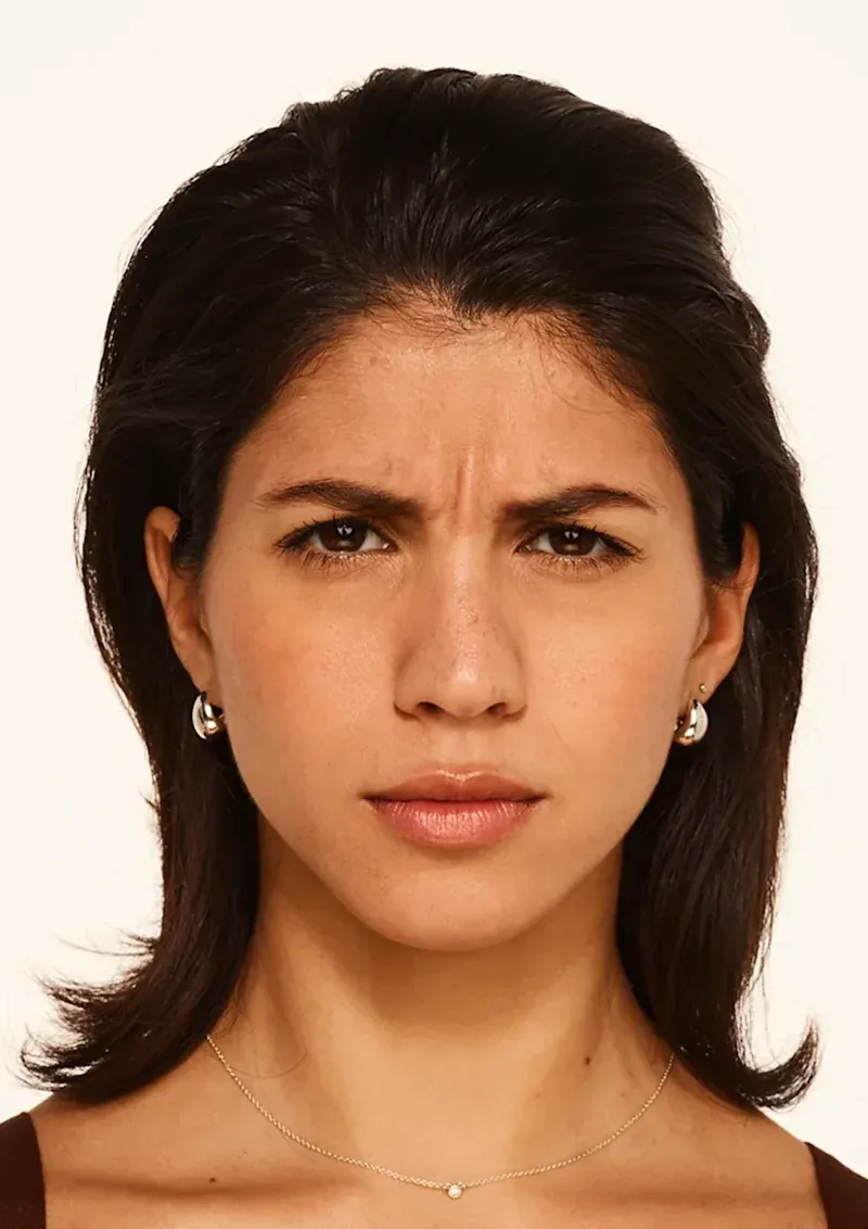Before BOTOX Cosmetic treatment, Allergan Aesthetics manufacturer clinical photo