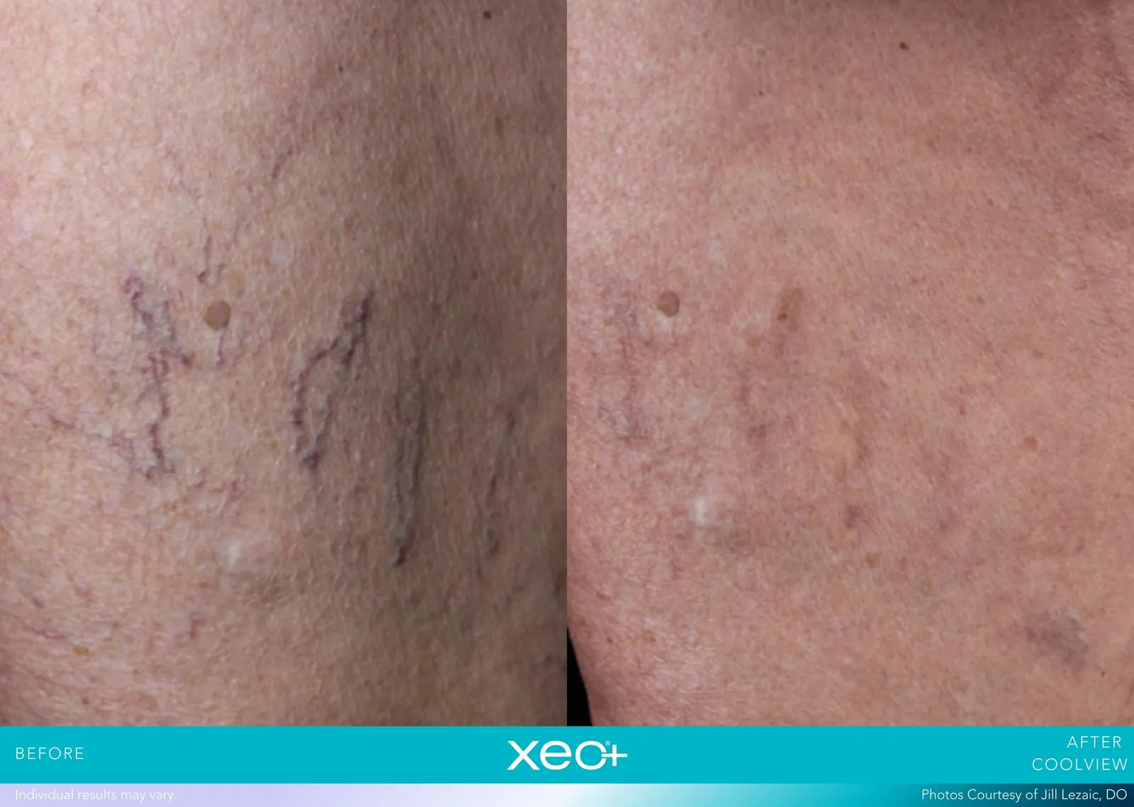Before and after CoolView treatment, Cutera xeo+ manufacturer clinical photo