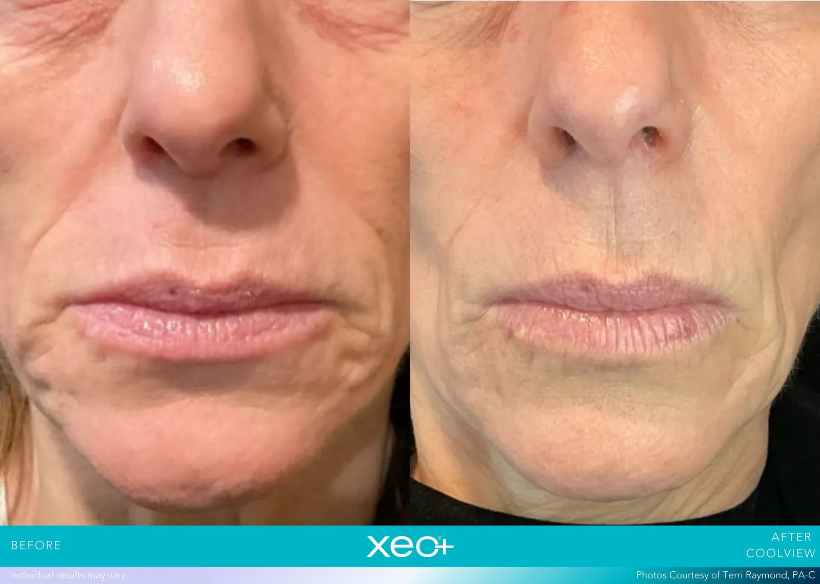 Before and after CoolView treatment, Cutera xeo+ manufacturer clinical photo