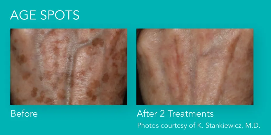 Excel V+: Age spots, before and after 2 treatments, Cutera Excel V+ manufacturer clinical photo