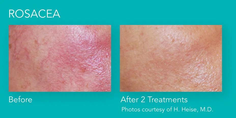 Excel V+: Rosacea, before and after 2 treatments, Cutera Excel V+ manufacturer clinical photo
