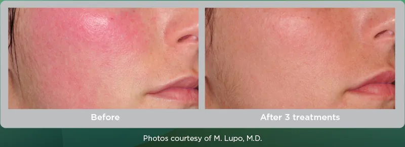 Excel V+: Rosacea, before and after 3 treatments, Cutera Excel V+ manufacturer clinical photo