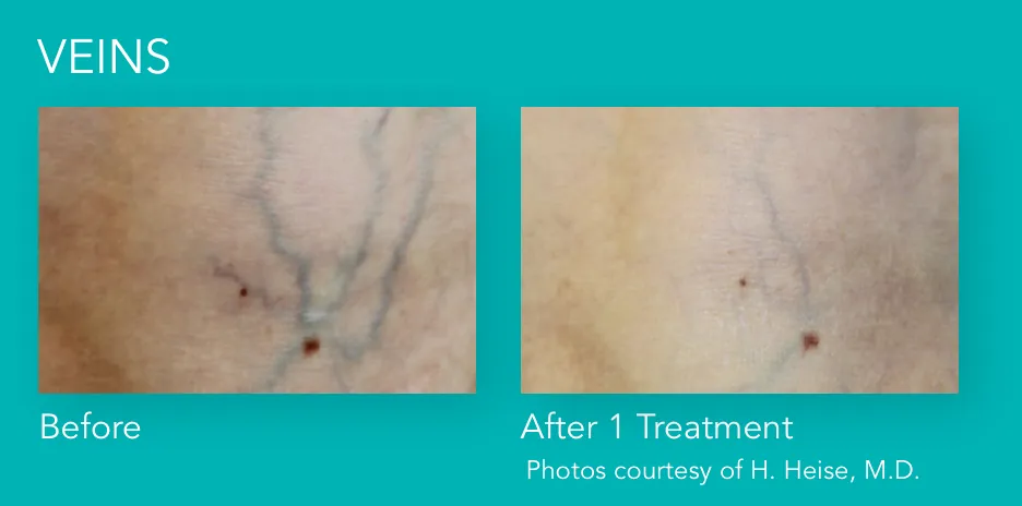 Excel V+: Veins, before and after 1 treatment, Cutera Excel V+ manufacturer clinical photo