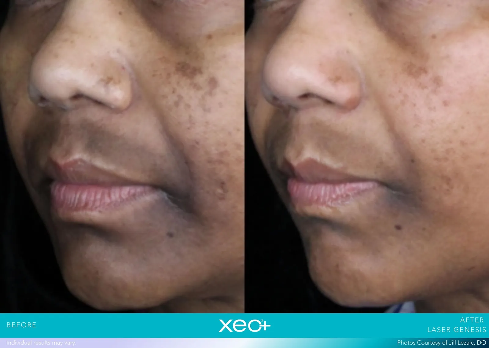 Before and after Laser Genesis treatment, Cutera xeo+ manufacturer clinical photo