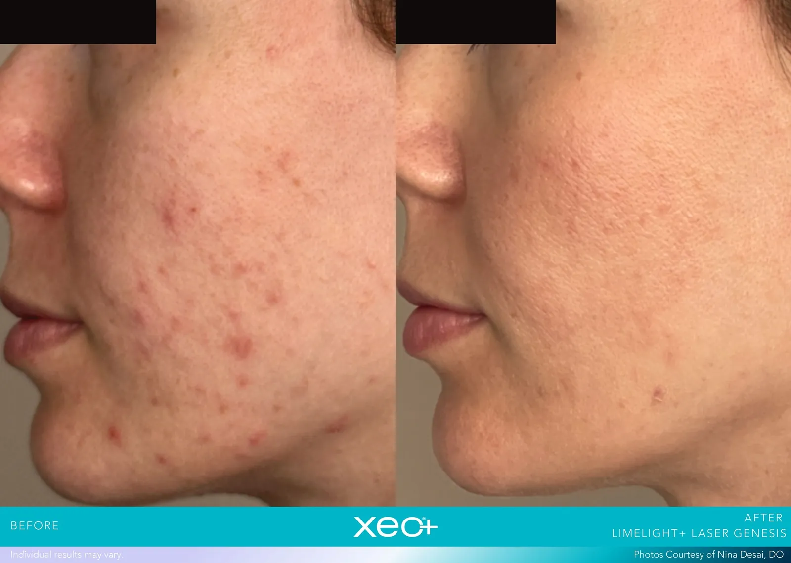 Before and after LimeLight + Laser Genesis treatment, Cutera xeo+ manufacturer clinical photo