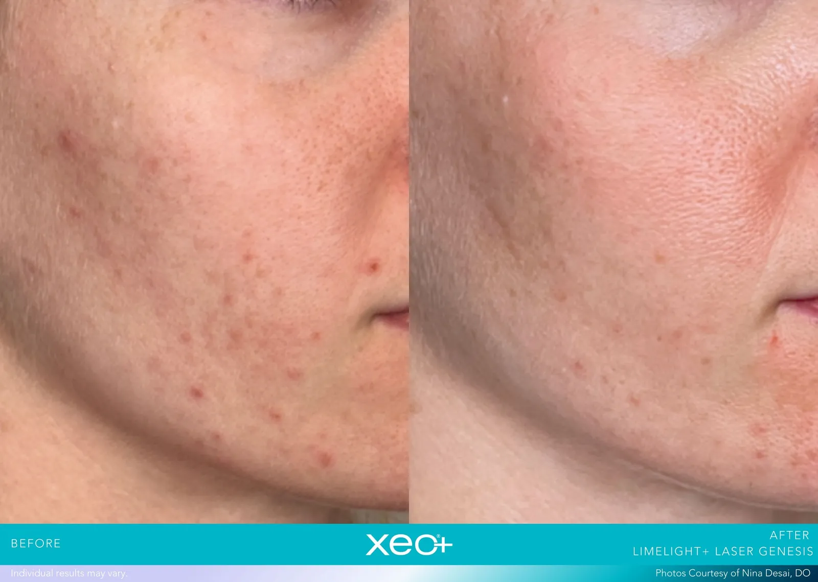 Before and after LimeLight + Laser Genesis treatment, Cutera xeo+ manufacturer clinical photo