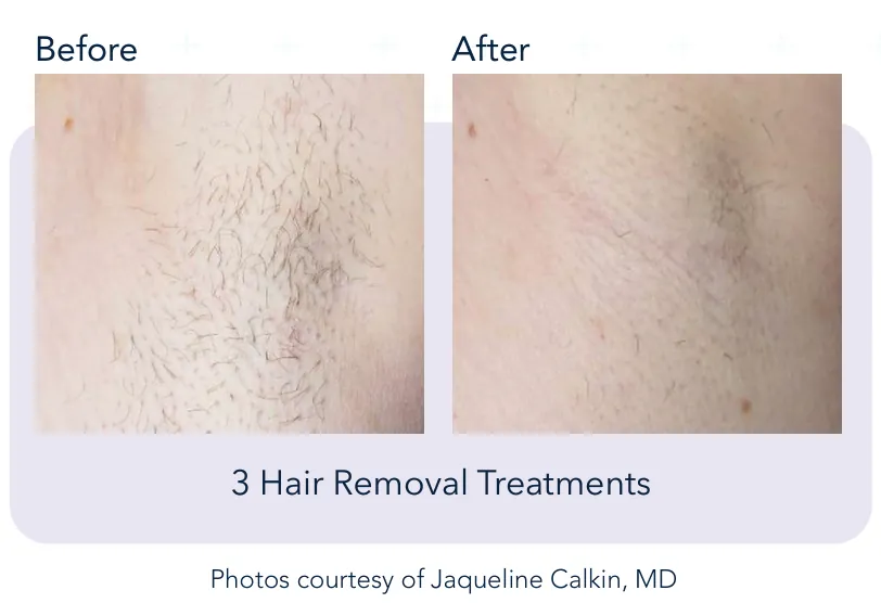 Prowave hair removal: before and after 3 hair removal treatments, Cutera clinical photo