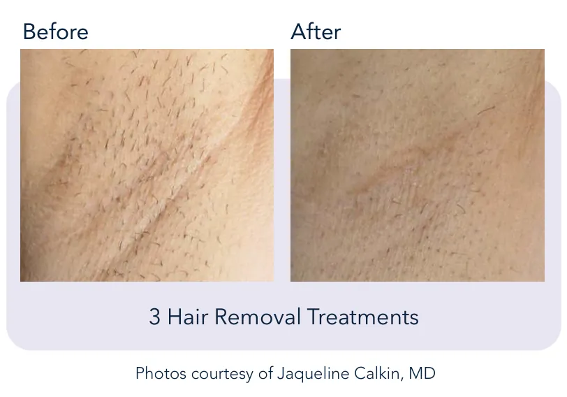 Prowave hair removal: before and after 3 hair removal treatments, Cutera clinical photo