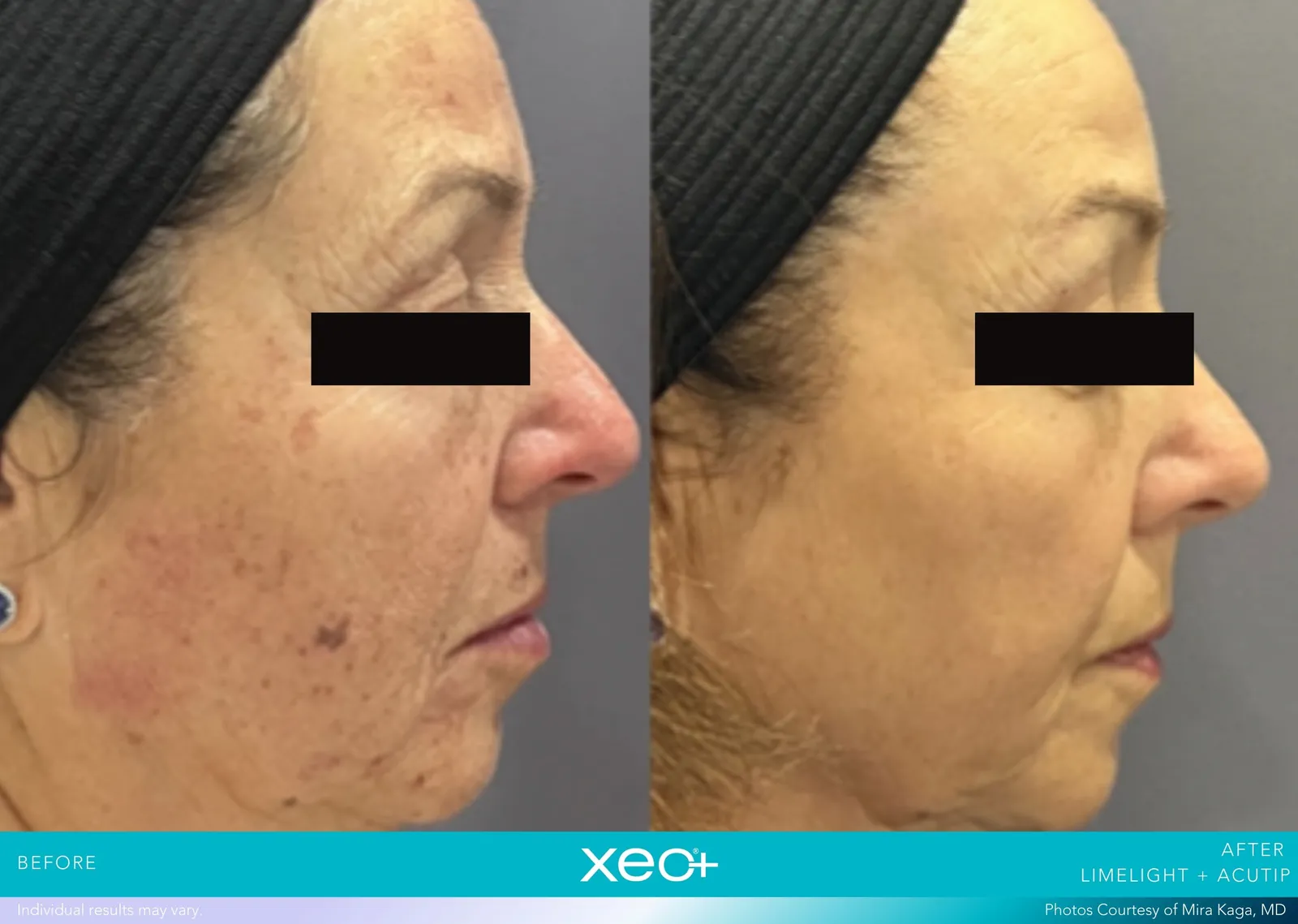 Before and after LimeLight + AcuTip treatment, Cutera xeo+ manufacturer clinical photo