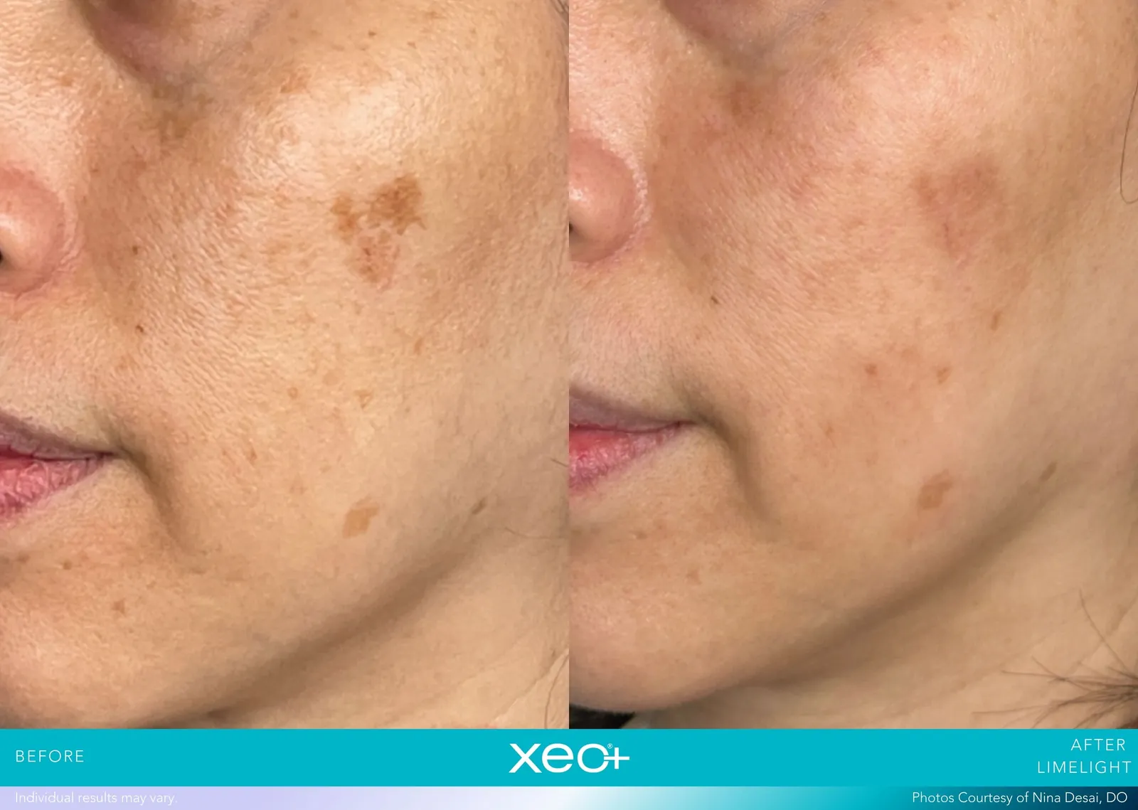 Before and after LimeLight treatment, Cutera xeo+ manufacturer clinical photo