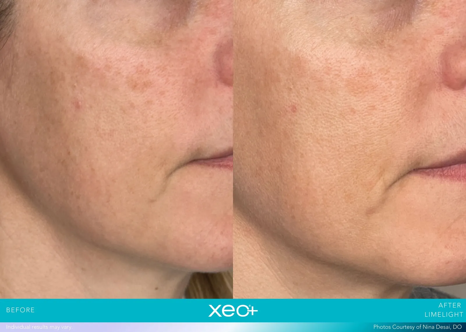 Before and after LimeLight treatment, Cutera xeo+ manufacturer clinical photo
