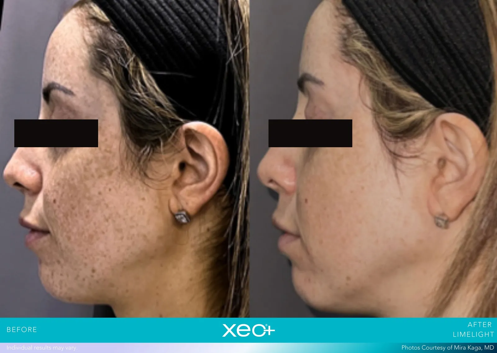 Before and after LimeLight treatment, Cutera xeo+ manufacturer clinical photo