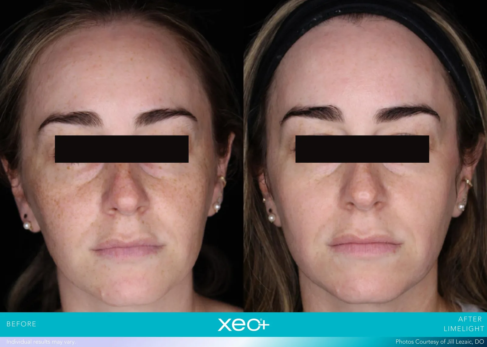 Before and after LimeLight treatment, Cutera xeo+ manufacturer clinical photo