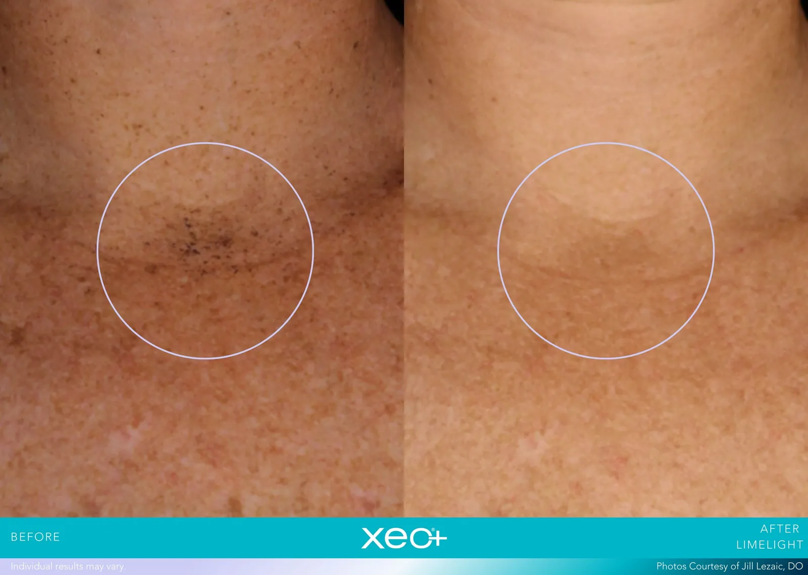 Before and after LimeLight treatment, Cutera xeo+ manufacturer clinical photo