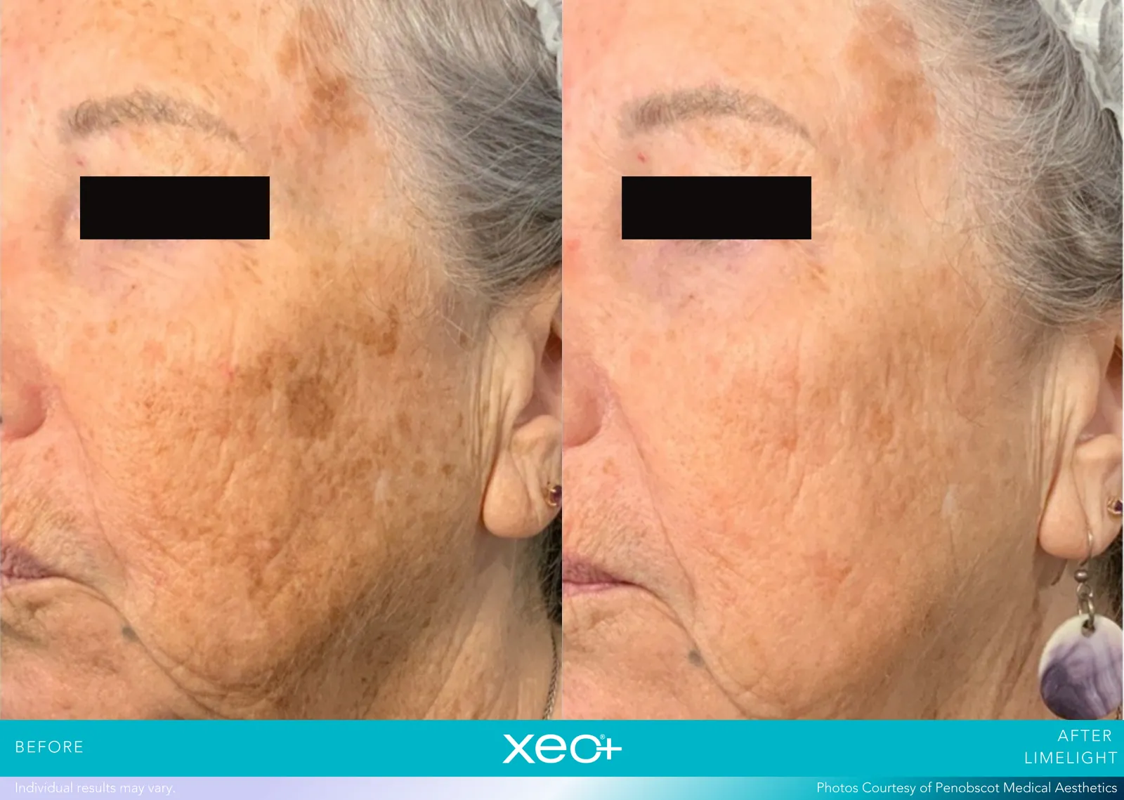 Before and after LimeLight treatment, Cutera xeo+ manufacturer clinical photo