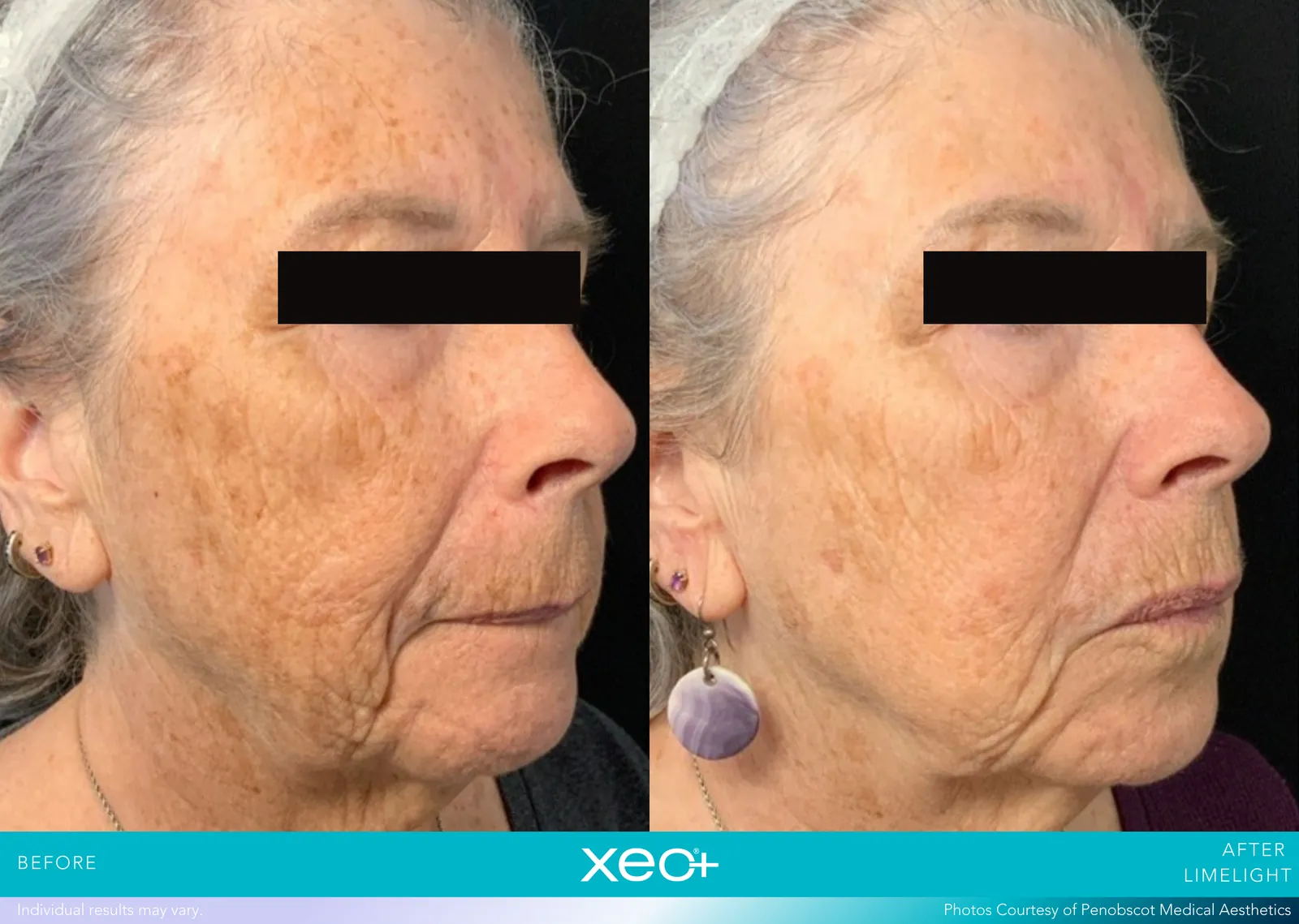 Before and after LimeLight treatment, Cutera xeo+ manufacturer clinical photo
