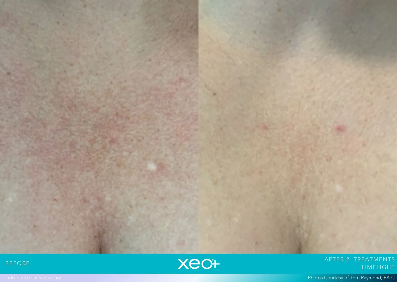 Before and after LimeLight treatment, Cutera xeo+ manufacturer clinical photo