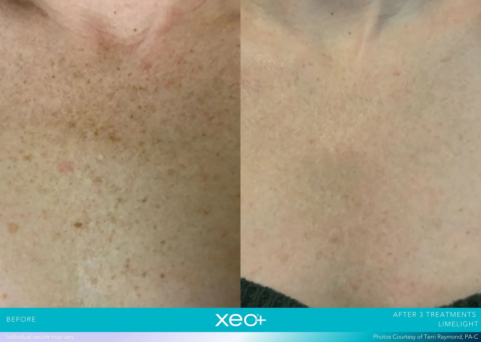 Before and after LimeLight treatment, Cutera xeo+ manufacturer clinical photo