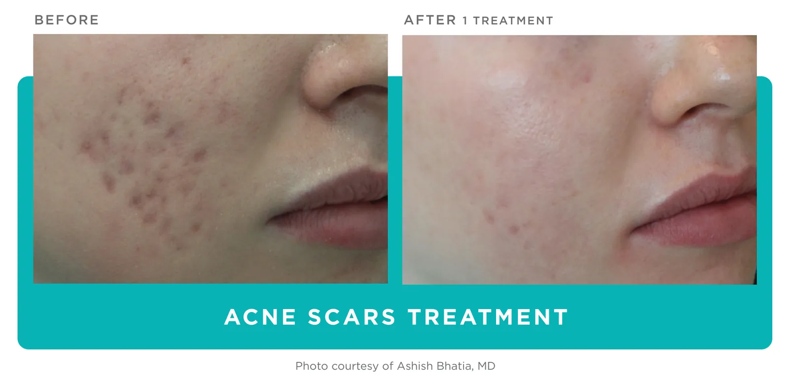 Secret PRO: Acne scars, before and after 1 treatment, Cutera Secret PRO manufacturer clinical photo