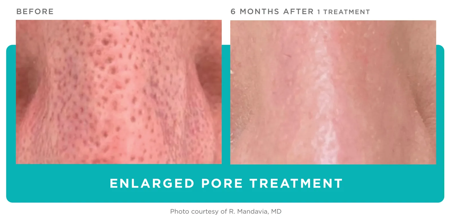 Secret PRO: Enlarged pores, before and 6 months after 1 treatment, Cutera clinical photo