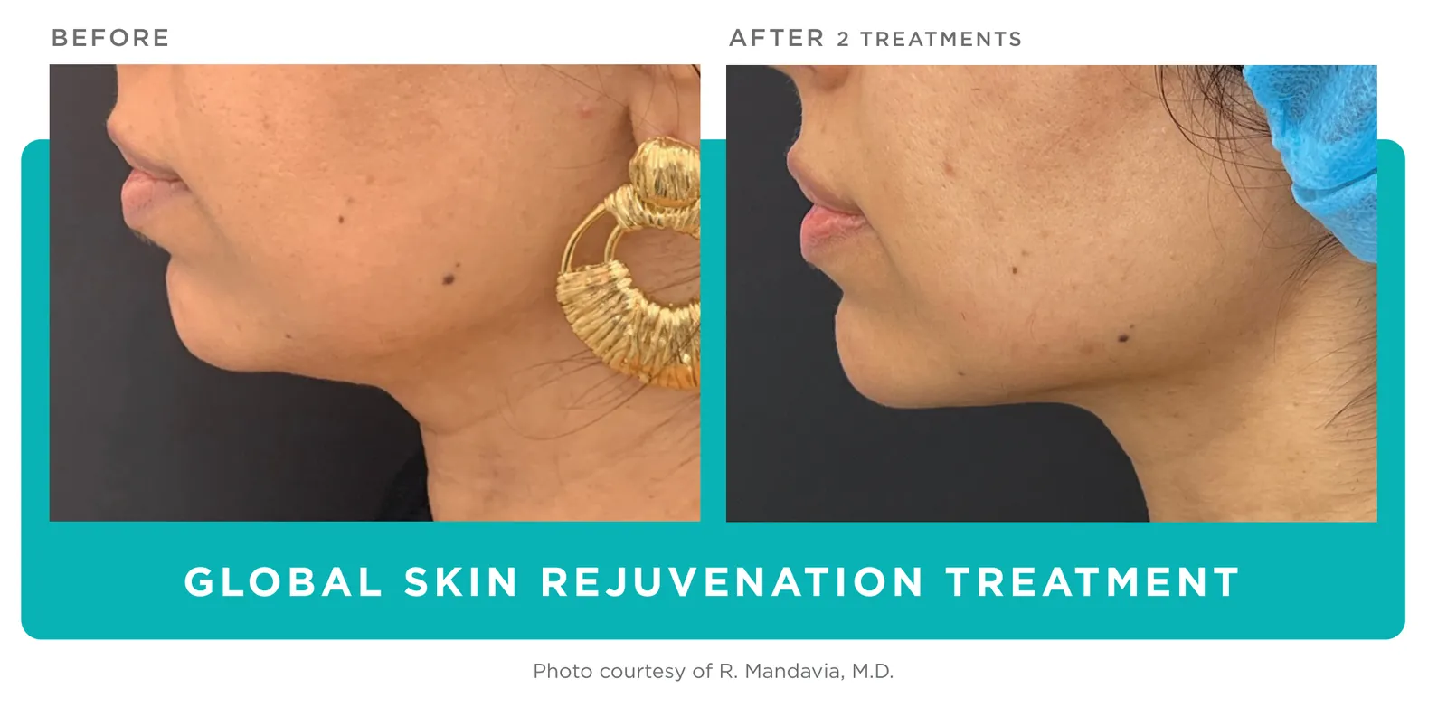 Secret PRO: Global skin rejuvenation, before and after 2 treatments, Cutera clinical photo