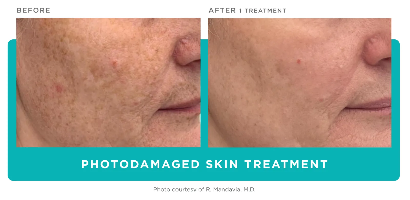 Secret PRO: Photodamaged skin, before and after 1 treatment, Cutera clinical photo