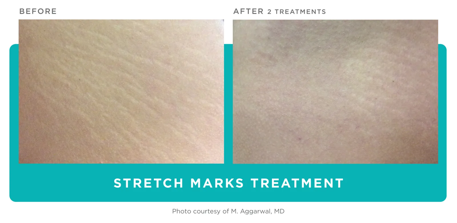 Secret PRO: Stretch marks, before and after 2 treatments, Cutera clinical photo