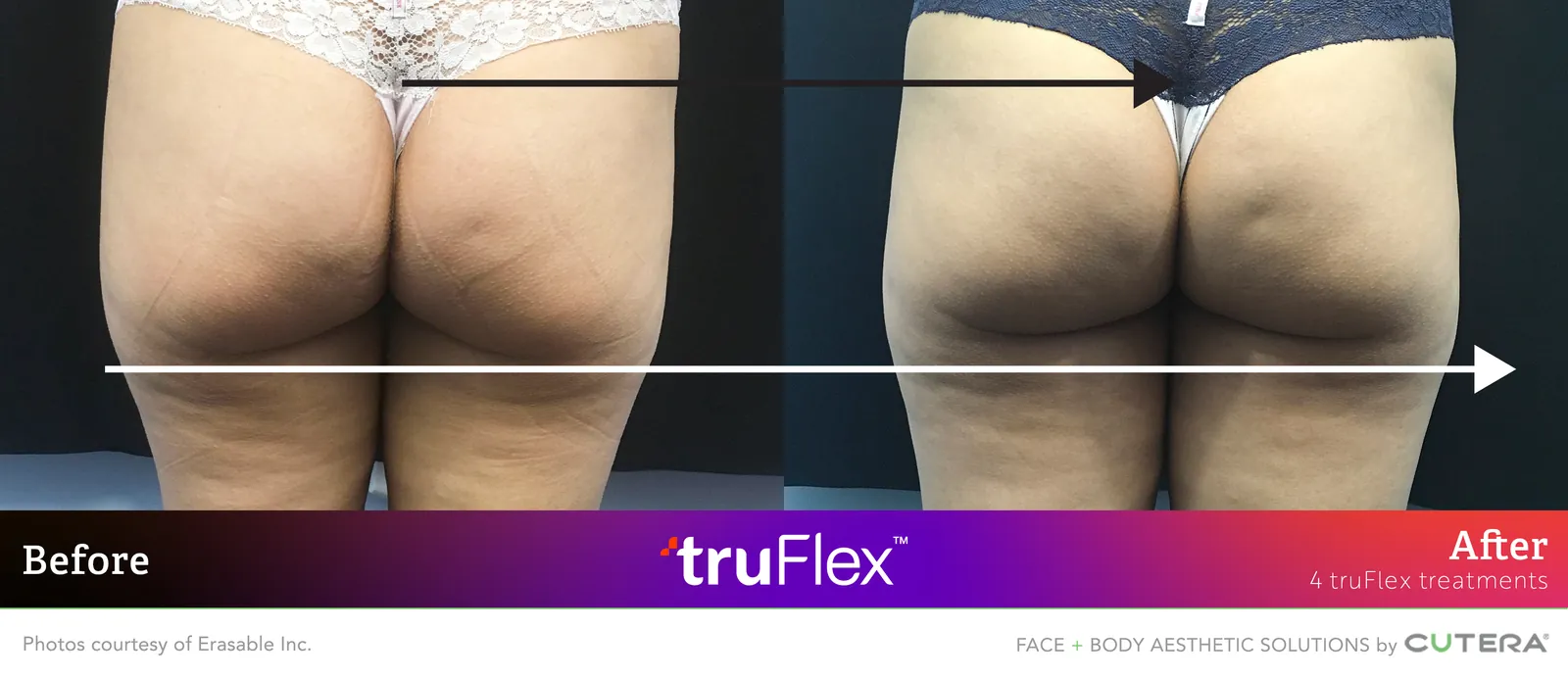 Before and after 4 truFlex treatments, Cutera truFlex manufacturer clinical photo