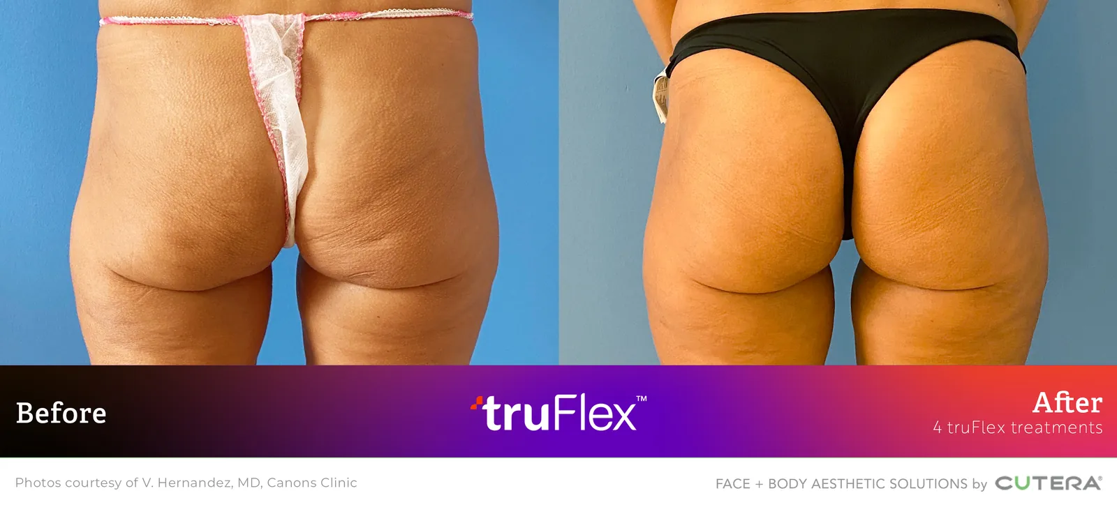 Before and after 4 truFlex treatments, Cutera truFlex manufacturer clinical photo