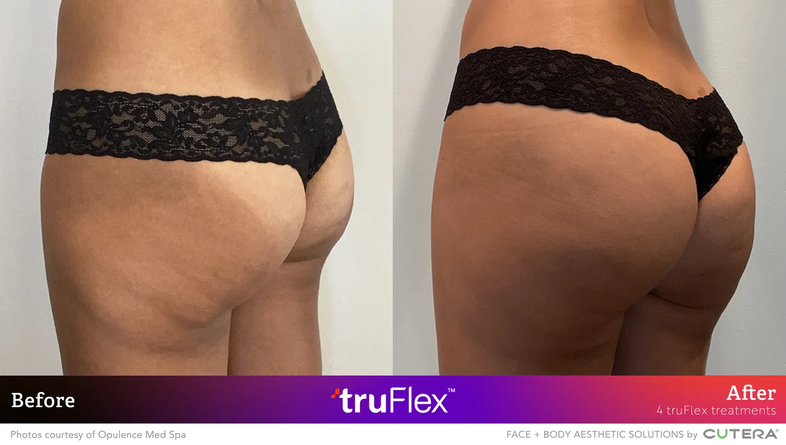 Before and after 4 truFlex treatments, Cutera truFlex manufacturer clinical photo