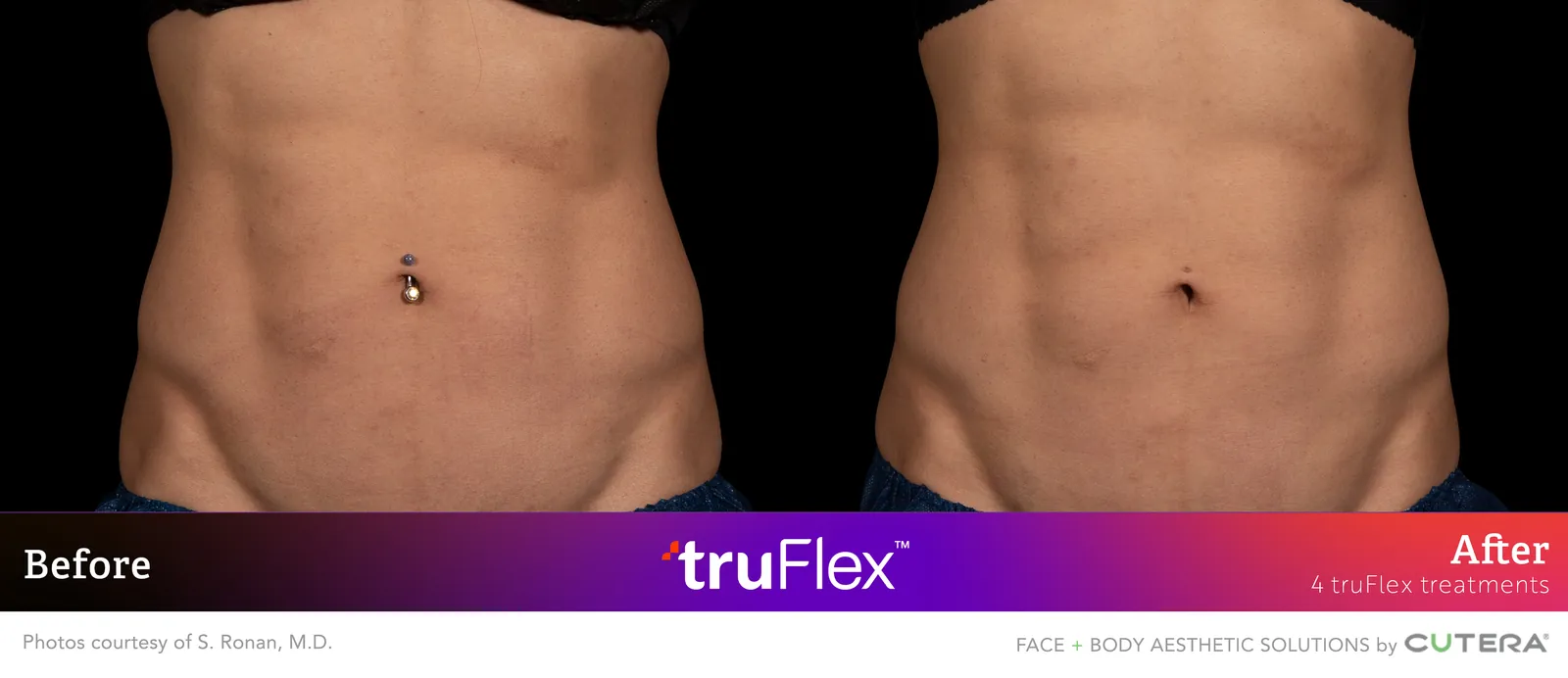 Before and after 4 truFlex treatments, Cutera truFlex manufacturer clinical photo