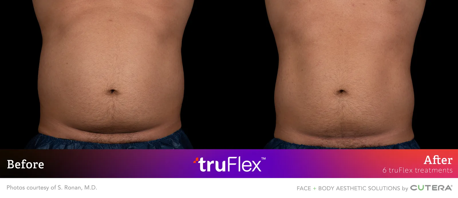Before and after 6 truFlex treatments, Cutera truFlex manufacturer clinical photo