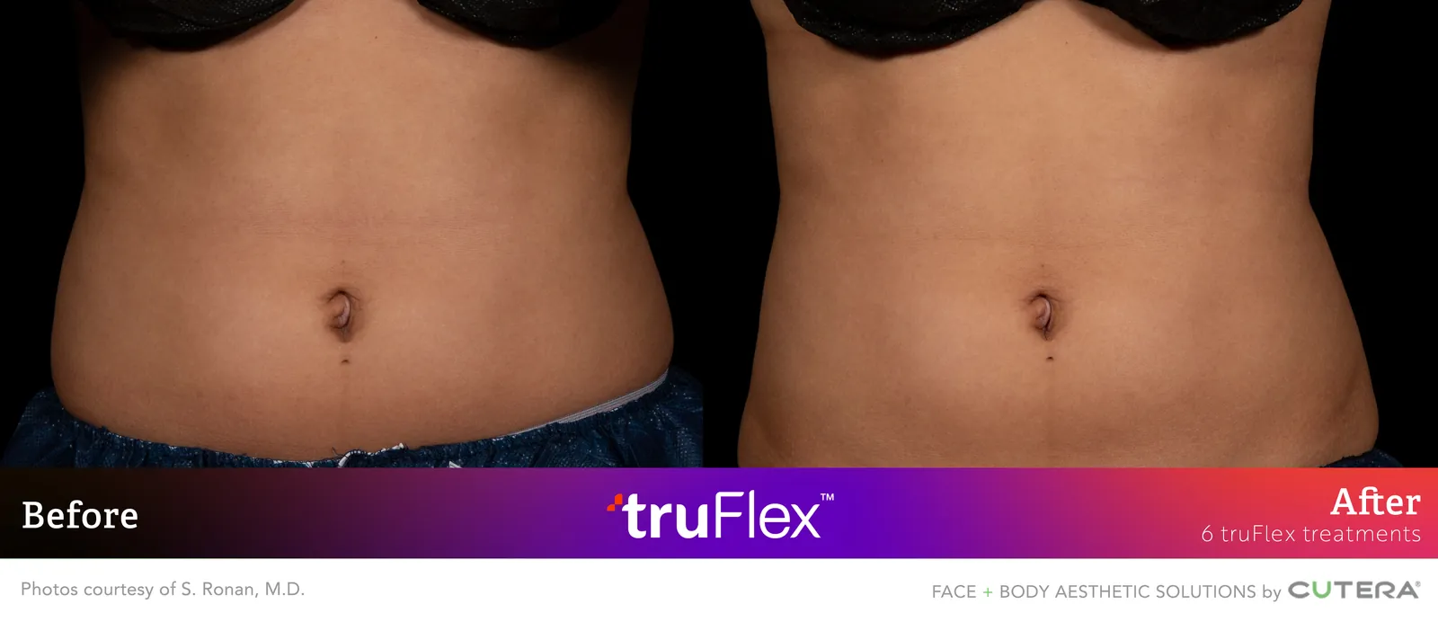 Before and after 6 truFlex treatments, Cutera truFlex manufacturer clinical photo