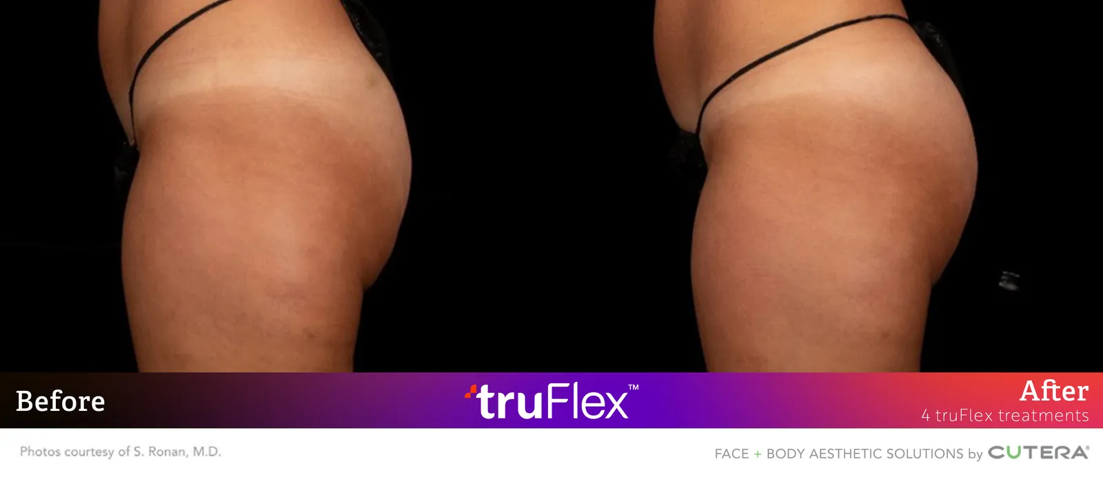 Before and after 4 truFlex treatments, Cutera truFlex manufacturer clinical photo