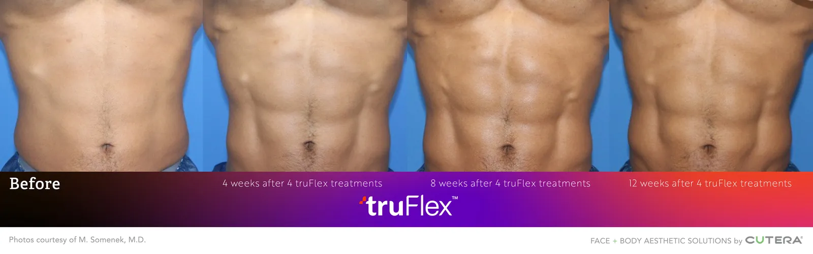 Before and after 4 truFlex treatments, at 4, 8 and 12 weeks, Cutera clinical photo