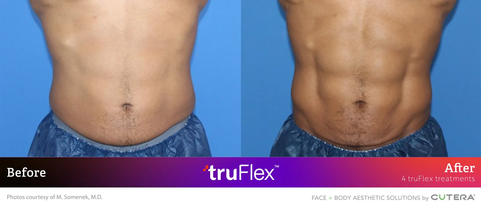 Before and after 4 truFlex treatments, Cutera truFlex manufacturer clinical photo