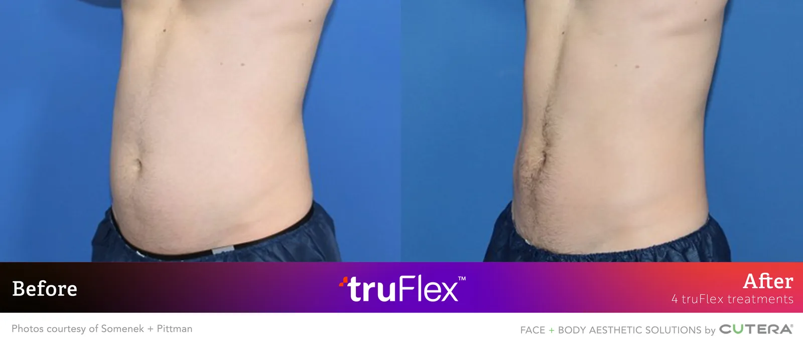 Before and after 4 truFlex treatments, Cutera truFlex manufacturer clinical photo