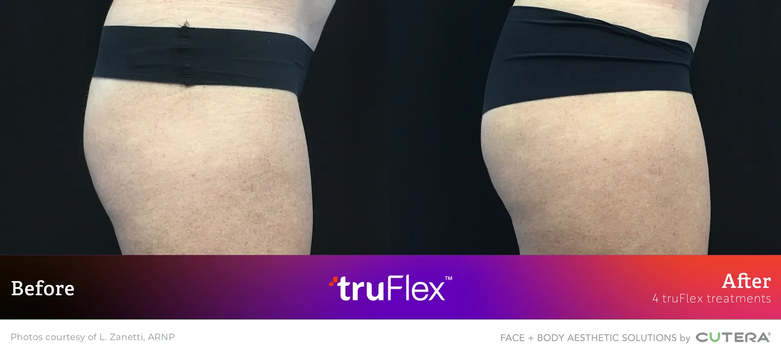 Before and after 4 truFlex treatments, Cutera truFlex manufacturer clinical photo